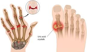 Pija që shpërbën kristalet e acidit urik të grumbulluara në nyje e kyçe; Si  të shpëtoni një herë e mirë nga dhimbjet - Telegrafi - Telegrafi