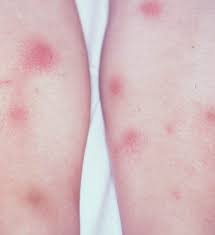 Image result for erythema nodosum