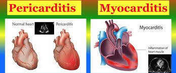 Image result for Myocarditis