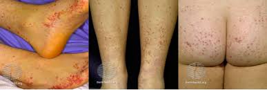 Depending on their size, purpuric lesions are traditionally classified as petechiae (pinpoint hemorrhages less than 2 mm in greatest diameter), purpura (2 mm to 1 cm) or ecchymoses (more than 1 cm. Sick Or Not Sick A Case Of A Childhood Rash Brown Emergency Medicine