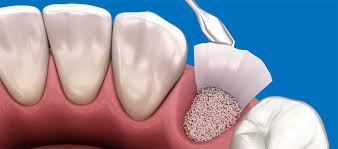 Image result for Alveolitis sicca)