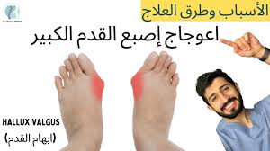 انحراف إصبع القدم الكبير الاسباب وطرق العلاج 3 تمارين - الوكعة - إبهام القدم  الأروح - Hallux Valgus - YouTube