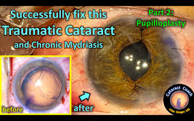 Image result for Mydriasis