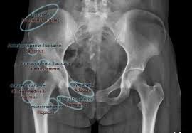 Our pelvic floor physical therapists treat men, women and children for pelvic floor dysfunction. Apophyseal Avulsion Fractures Are Usually The Result Of A Sudden Forceful Concentric Or Eccentric Contraction Of Radiology Radiology Imaging Radiology Student