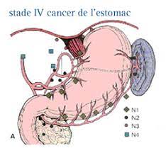 Cancer du poumon 4 stade, les symptômes avant la mort. Infocancer Arcagy Gineco Appareil Digestif Cancer De L Estomac Gastrique Formes De La Maladie Les Differents Stades