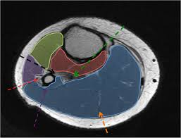 Muscle anatomy mri hamstring tendon anatomy mri posterior thigh muscles anatomy thigh sarcoma mri piriformis muscle mri anatomy sartorius mri sagittal mri knee anatomy gracilis mri thigh muscle anatomy cross section mri femoral explore more like upper thigh mri anatomy. Epos P 0065