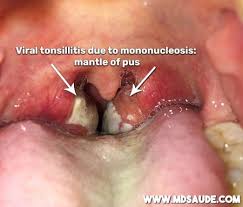 Image result for Tonsillitis