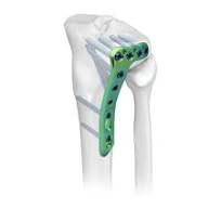 Distal Humeral Sub-condylar Locking Plate,Medical Device ...