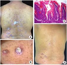 Image result for human papillomavirus symptoms