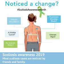 When you start your yoga practice to improve your scoliosis it's very important to know your curve pattern and be aware of your imbalances. A Scoliosis Journey Week 1 Scoliosis Clinic Uk Treating Scoliosis Without Surgery
