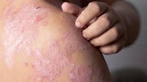 Image result for Eczema nummulare