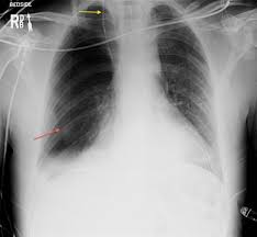 Image result for Pneumothorax