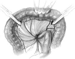Check spelling or type a new query. 22 Colon Carcinoma Treatment Abdominal Key