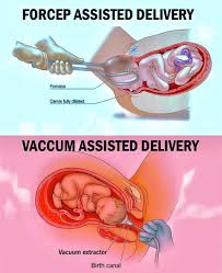 Image result for Vacuum Caput