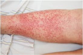 The initial signs of senile purpura are purple or red bruises that have an irregular shape. Acrally Distributed Dermatoses Vascular Dermatoses Purpura And Vasculitis Sciencedirect