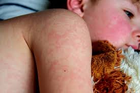 Image result for sweat rash on back baby