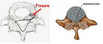 If the disc bulge is left untreated, then the prolonged disc bulge results in tear of the annular ring, out of which the spinal disc protrudes, after which this condition is then known as disc herniation. Lower Back Herniated Discs