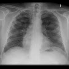 Chest radiography remains the initial modality for the detection and characterization of pleural and parenchymal disease. Asbestos Pleural Plaques Radiology Case Radiopaedia Org