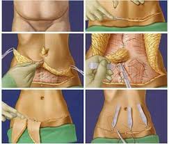 abdominoplastiacirurgia excesso musculatu pele remocao sutura abdominop cirugia de abdominoplastia abdominoplastia antes y despues cirugia de mamas