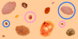 The Panicker S Guide To Moles And Skin Cancer How To Tell If Your Moles Are At Risk Of Becoming Cancerous moles and skin cancer