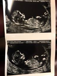 If that is clear, too, you have a good chance of having a health baby. Nuchal Translucency Came Back Abnormal April 2019 Babies Forums What To Expect