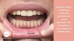 Many different issues can cause a swollen gum around one tooth, including periodontal disease or a dental abscess. The Difference Between Plaque And Calculus Method Dental