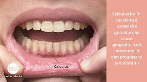 There is a mass of bleaching techniques. The Difference Between Plaque And Calculus Method Dental