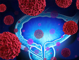 Once a tumor causes your prostate gland to swell, or once cancer spreads beyond your prostate, you may have symptoms including: What Is Metastatic Prostate Cancer Prostate Cancer Foundation