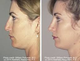 Dorsal Hump Removal Before And After Photo Gallery Nose Surgery Photos Patient 2 Nose Surgery Nose Plastic Surgery Rhinoplasty