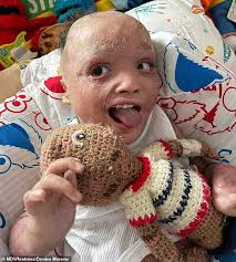 Two-year-old survives house fire with horrific burns across 95% of his body 