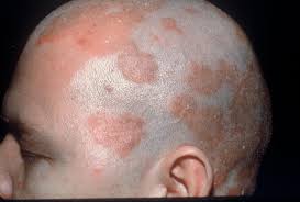 Seborrheic dermatitis is one of the most common skin disorders in the world, with 70 percent of infants and approximately 11.6 percent of the general population affected. Hair Loss Scalp Disorder Seborrheic Dermatitis Baruch Hair Loss Clinic
