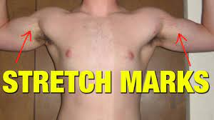 Trusted retailer of health & beauty products since 2001. How To Remove Stretch Marks Youtube