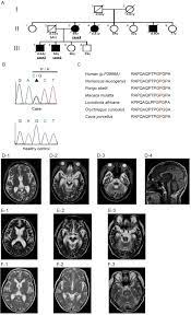 Mutations In Bassoon In Individuals With Familial And Sporadic Progressive Supranuclear Palsy Like Syndrome Scientific Reports