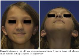 A Novel Technique for Early Rhinoplasty: A 12-Year Review