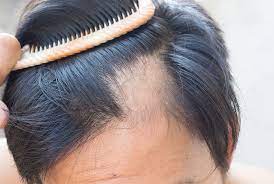 This doctor specializes in treating skin, hair and nails. Specialist Dermatology Alopecia Female Hairloss Itchy Scalp Male Balding