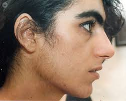 This facial hair growth could be an indication of something wrong with your health. Hirsutism What Causes Excessive Hair Growth In Women