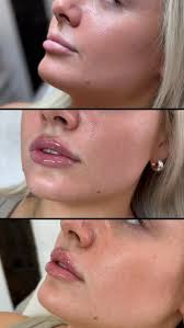 My beautiful client wanted to keep her lips looking natural yet more  defined., By softly enhancing the borders with just a minimal amount of  filler, we created natural symmetry while preserving her ...