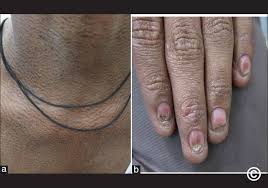 Image result for Diffuse Hyperpigmentation