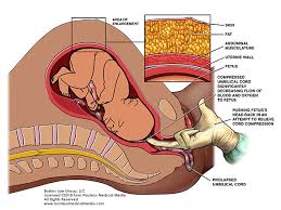 Umbilical Cord Prolapse Boston Law Group Llc