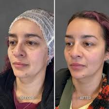 Albuquerque Laser Treatment Before & After Gallery: Chrome Aesthetics