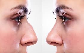 울퉁불퉁 매부리코를 위한 맞춤형 수술은? < 전문가칼럼 < 기사본문 - 하이닥