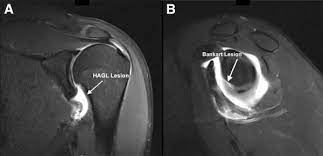 Hagl is a lightweight hardware agnostics graphics library. Mini Open Repair Of The Floating Anterior Inferior Glenohumeral Ligament Combined Treatment Of Bankart And Humeral Avulsion Of The Glenohumeral Ligament Lesions Sciencedirect