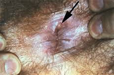 Image result for syphilis ulcer