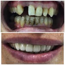 Çeşitli nedenlerle kaybedilen dişlerin yerinin doldurulması için veya estetik görüntünün sağlanması için yapılan uygulamalardır. Kaplamalar Discim Istanbul