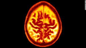 The drug, aducanumab, which will go by the brand name aduhelm, is a monthly intravenous infusion intended to slow cognitive decline in people, with mild memory and thinking problems. Aducanumab Fda Approves First New Alzheimer S Drug In Nearly 20 Years Cnn