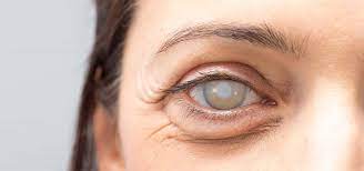 A cataract is a cloudy area in the lens of the eye that leads to a decrease in vision. Goz Hastaliklari Katarakt Ozel Atanur Goz Hastanesi Isparta Www Atanurgoz Com Tr