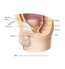 Sling Implantation In Men Patient Information