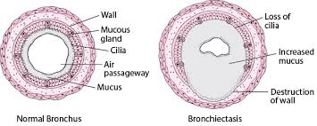 Bronchiectasis - Lung and Airway Disorders - MSD Manual Consumer Version