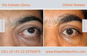 Tepezza is a prescription medicine used to treat ted. Thyroid Eye Disease Treatment Graves Eye Disease Surgery Cost India The Esthetic Clinics