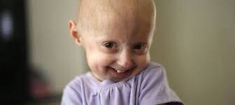 There are 400 children worldwide with progeria, a rapid-aging ...